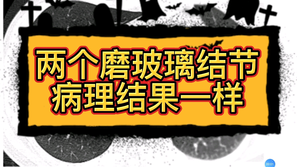 两个磨玻璃结节,病理结果一样看看CT上都有哪些特点?哔哩哔哩bilibili