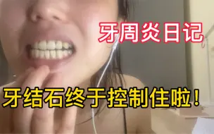 下载视频: 牙周炎日记｜牙结石控制住啦？！我哭