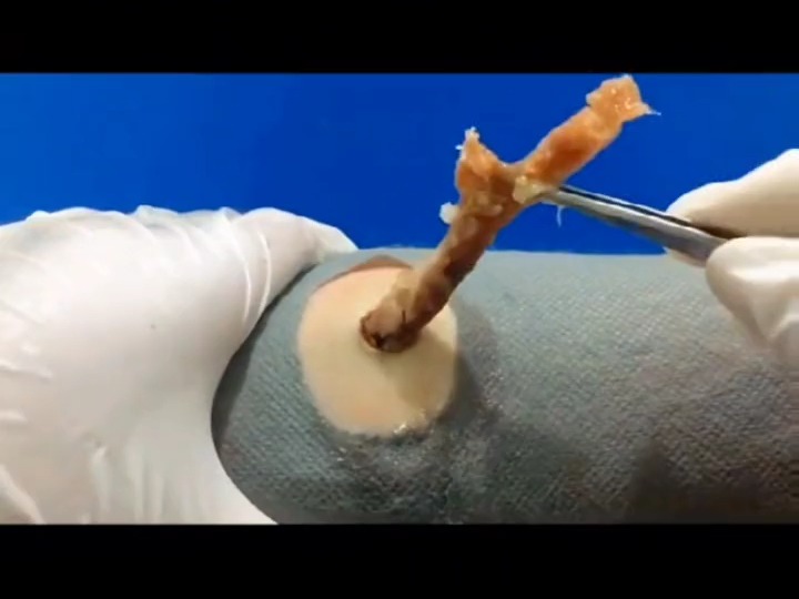 解压视频 #挤黑头粉刺#强迫症 #痘痘黑头粉刺拜拜