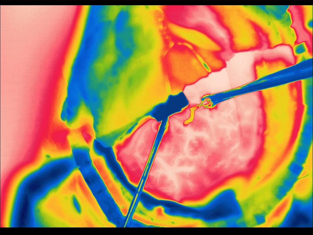 𐟎‰重大突破!国内首次提出应用红外热成像技术,精准评估烟雾病直接血运重建过程中吻合口血管的通畅性,为医学发展带来新希望.哔哩哔哩bilibili