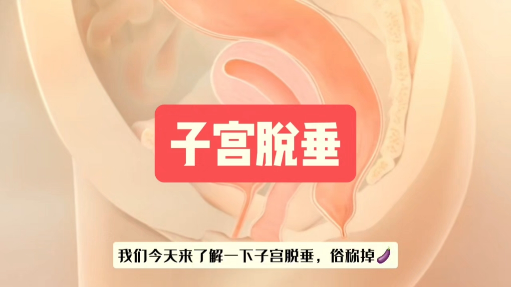 【子宫脱垂】理文老师产后恢复系列!哔哩哔哩bilibili