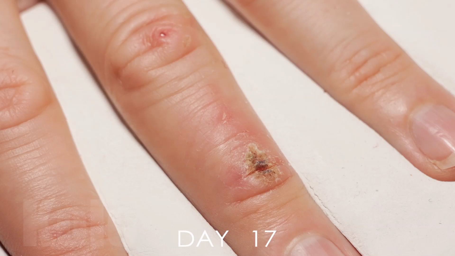 伤口在33天中愈合过程