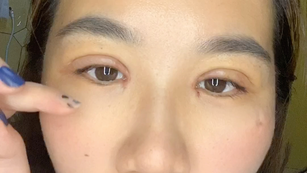 全切双眼皮去皮去脂开内外眼角第7天_哔哩哔哩 (゜-゜)つロ 干杯