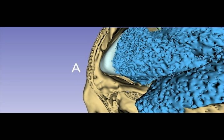 [图]3D slicer 重建分流-颅骨修补术后颅内积气患者额窦内部缺口