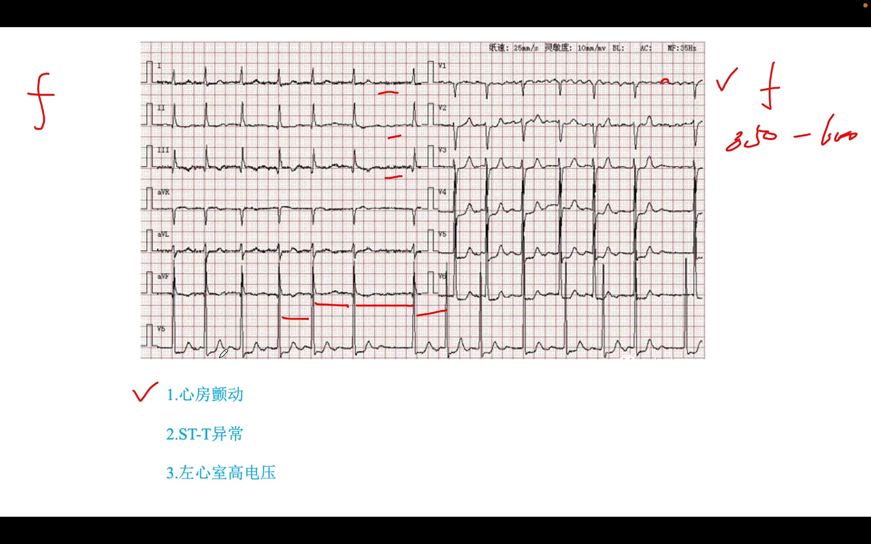 心电图五步读图法判读心电图之房颤、STT改变、左心室高电压哔哩哔哩bilibili