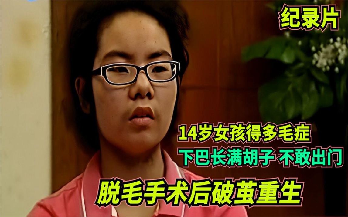 14歲女孩得多毛症,下巴長滿鬍子不敢出門,脫毛手術後破繭重生!