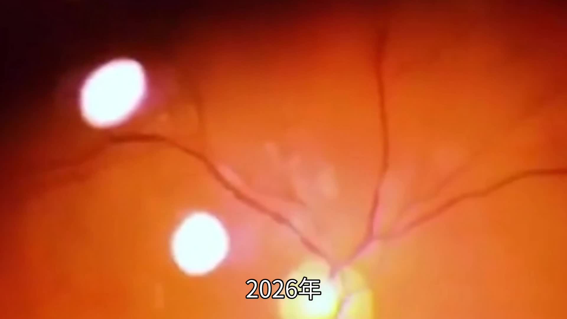 全国首例！国产脑机接口助力盲人成功复明