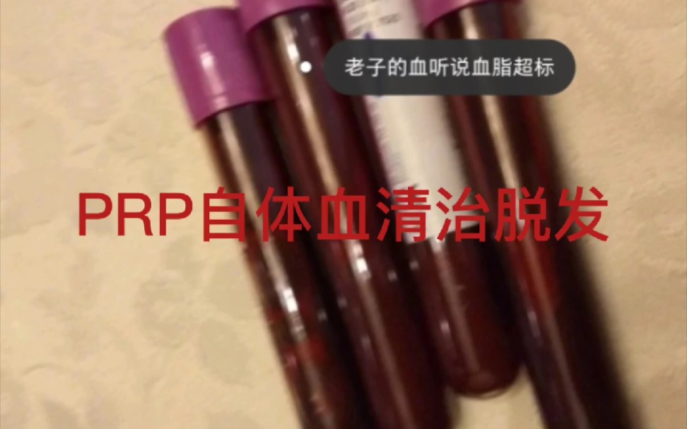 医美分享|我半途而废的PRP自体血清微针生发美容经历哔哩哔哩bilibili