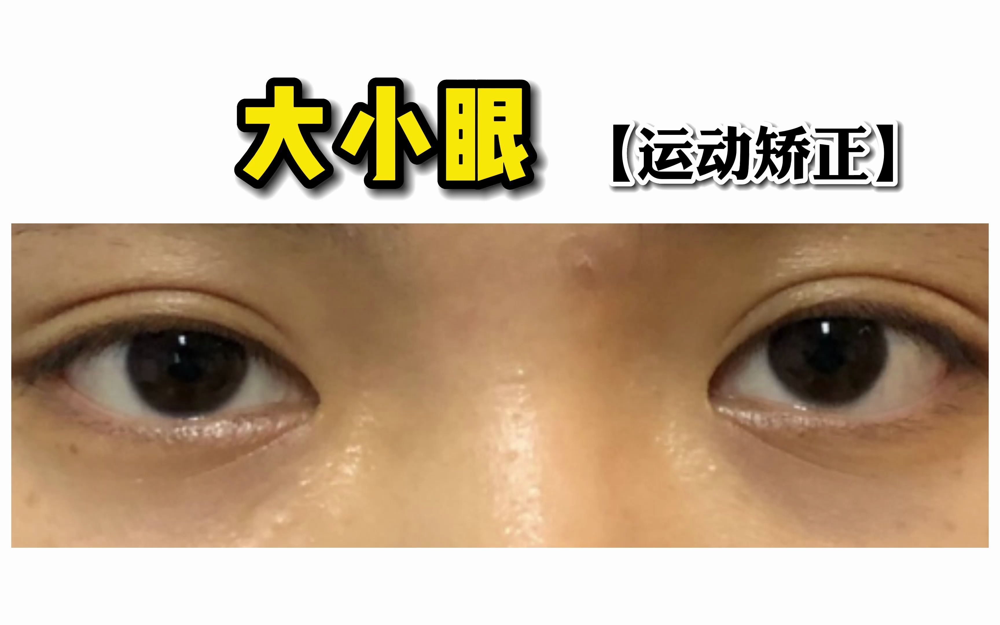 日本国宝级手术——眼睑下至，到底怎么样？ - 知乎