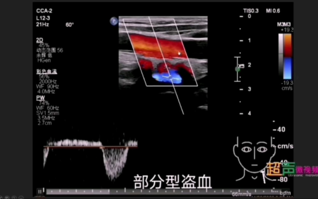 锁骨下动脉盗血超声表现,本期视频来自超声微视频哔哩哔哩bilibili