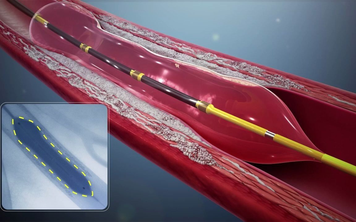 [图]Shockwave血管内碎石 (IVL) 系统 Shockwave Intravascular Lithotripsy (IVL) System