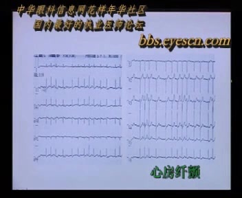 心电图讲解视频哔哩哔哩bilibili