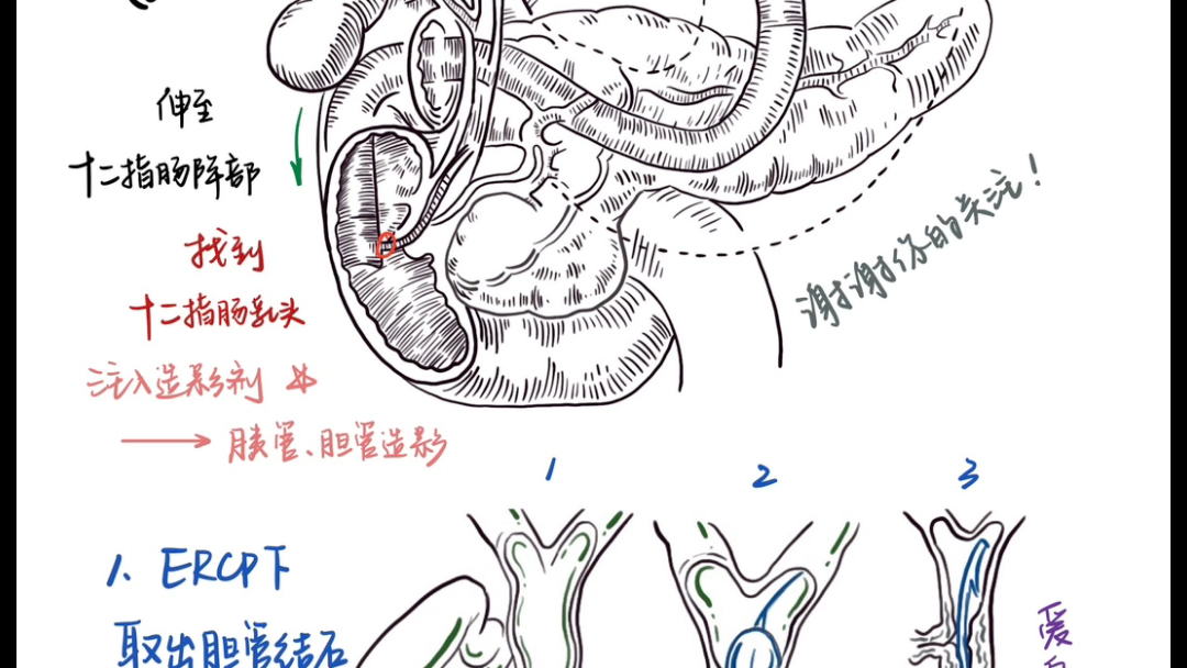 内科小笔记:ERCP经内镜逆行胆胰管造影术(红薯每日更新:爱臭美滴小企鹅)哔哩哔哩bilibili