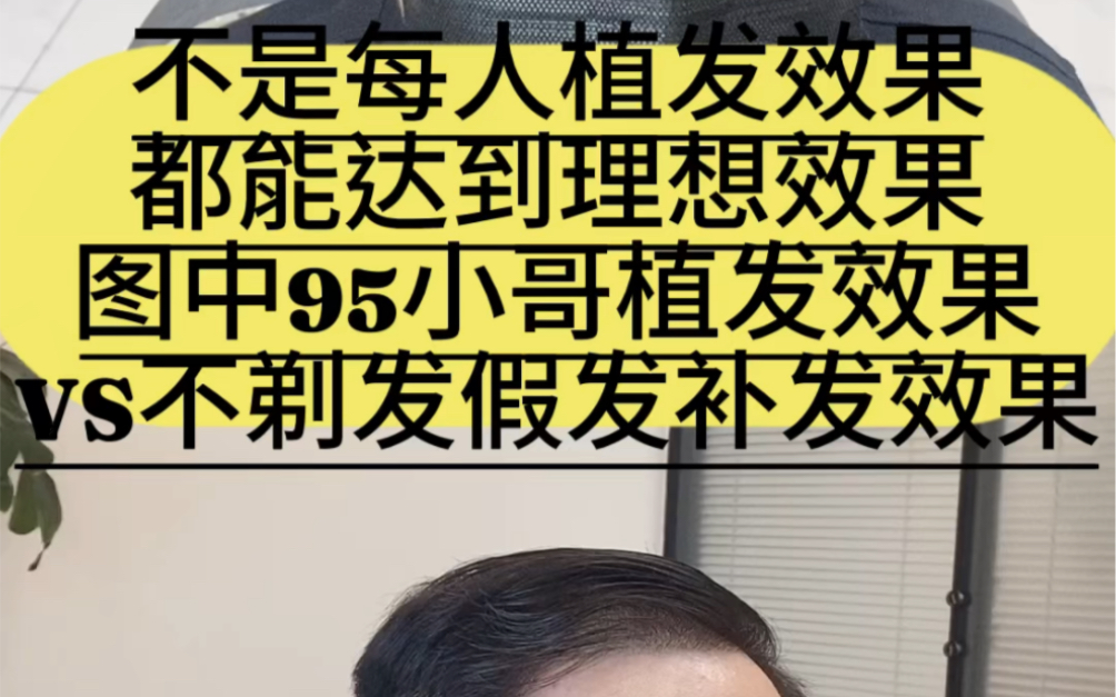 不一定每个植发效果都能达到预期VS不剃发假发补发哔哩哔哩bilibili