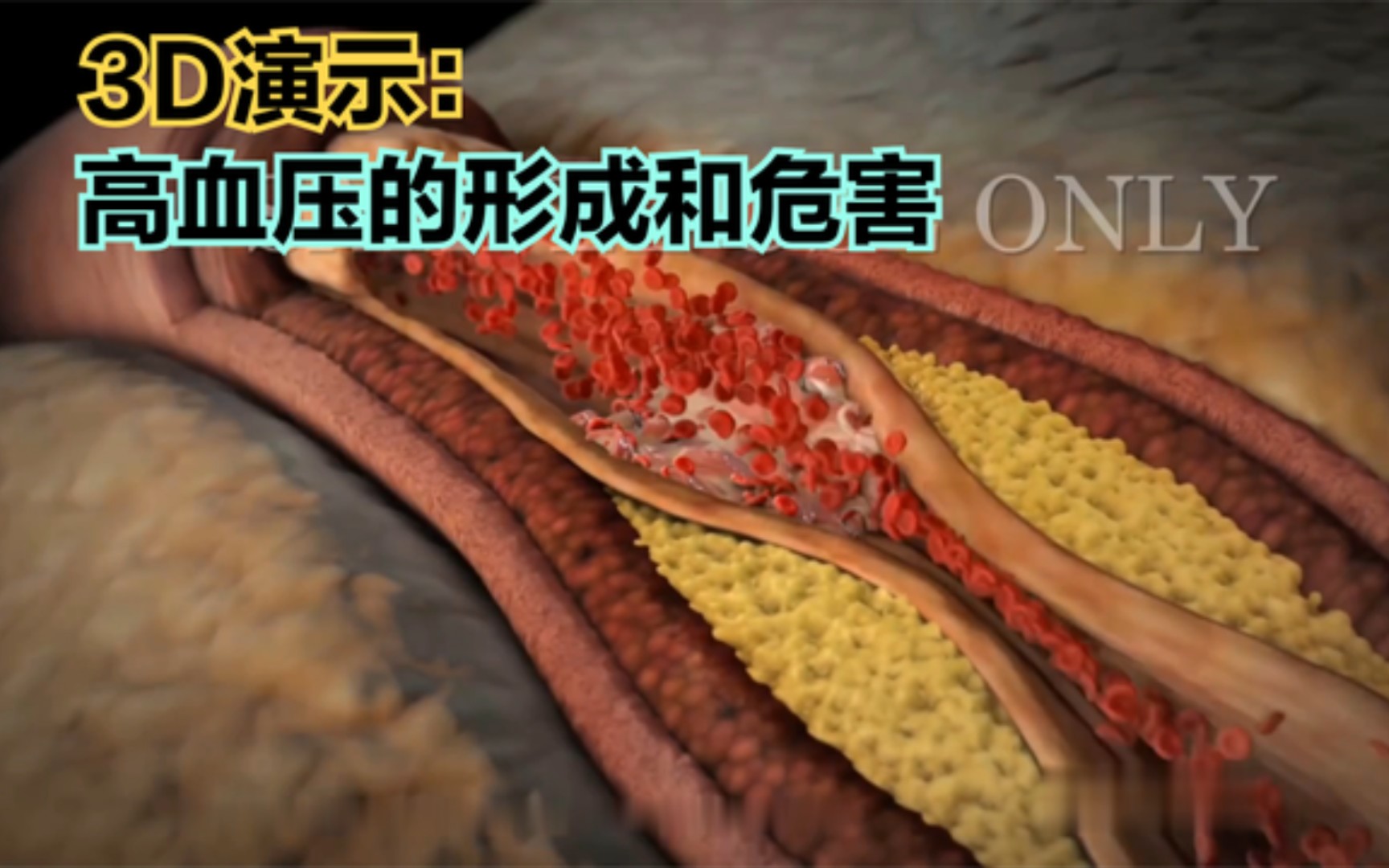 3D演示：高血压的形成和危害原理，你身边有高血压的人吗？