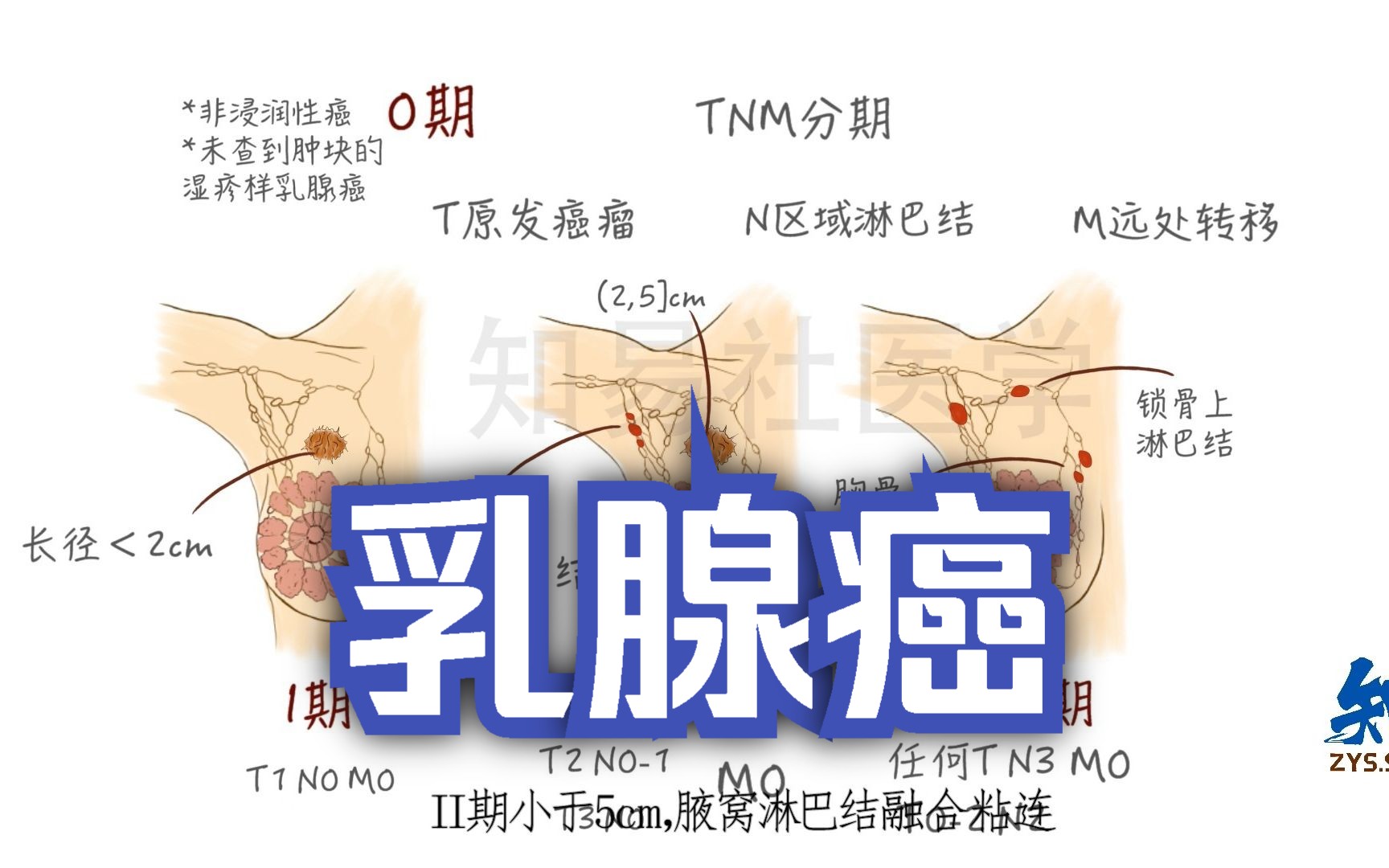 医学绘画 外科学考点 乳腺癌哔哩哔哩bilibili