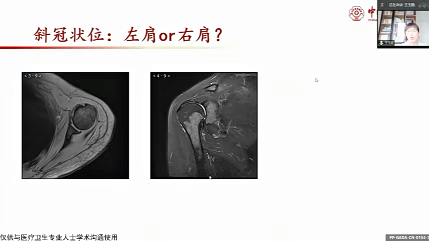 北京市医学影像技术质控论坛:脊柱和关节MR专题2.肩关节规范化扫描王玉丽哔哩哔哩bilibili