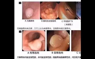 结肠息肉切除哔哩哔哩bilibili