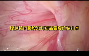 Download Video: 腹腔镜下腹股沟斜疝疝囊高位结扎术（儿童）