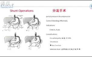 门静脉高压的分流术