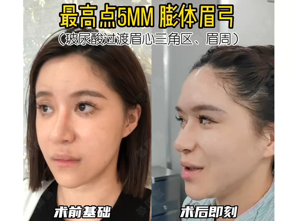 膨体眉弓 玻尿酸过渡,眉眼深邃了很多