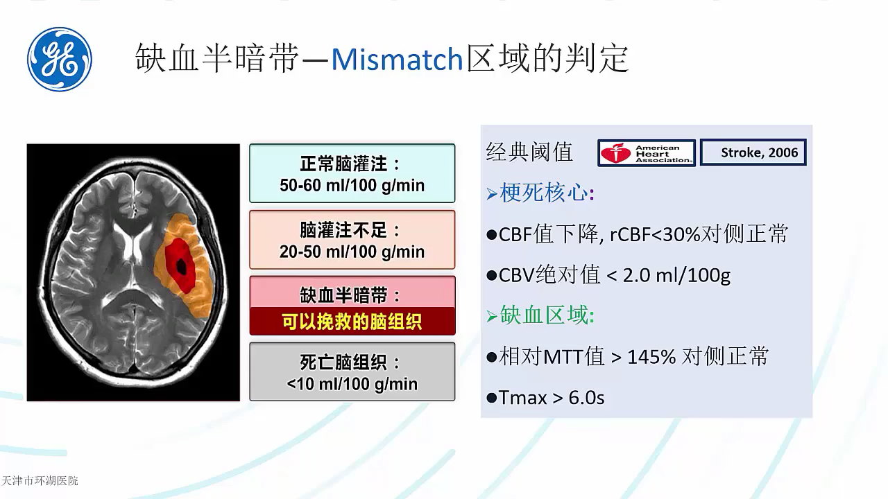 GE CT 脑卒中灌注扫描及后处理分析哔哩哔哩bilibili