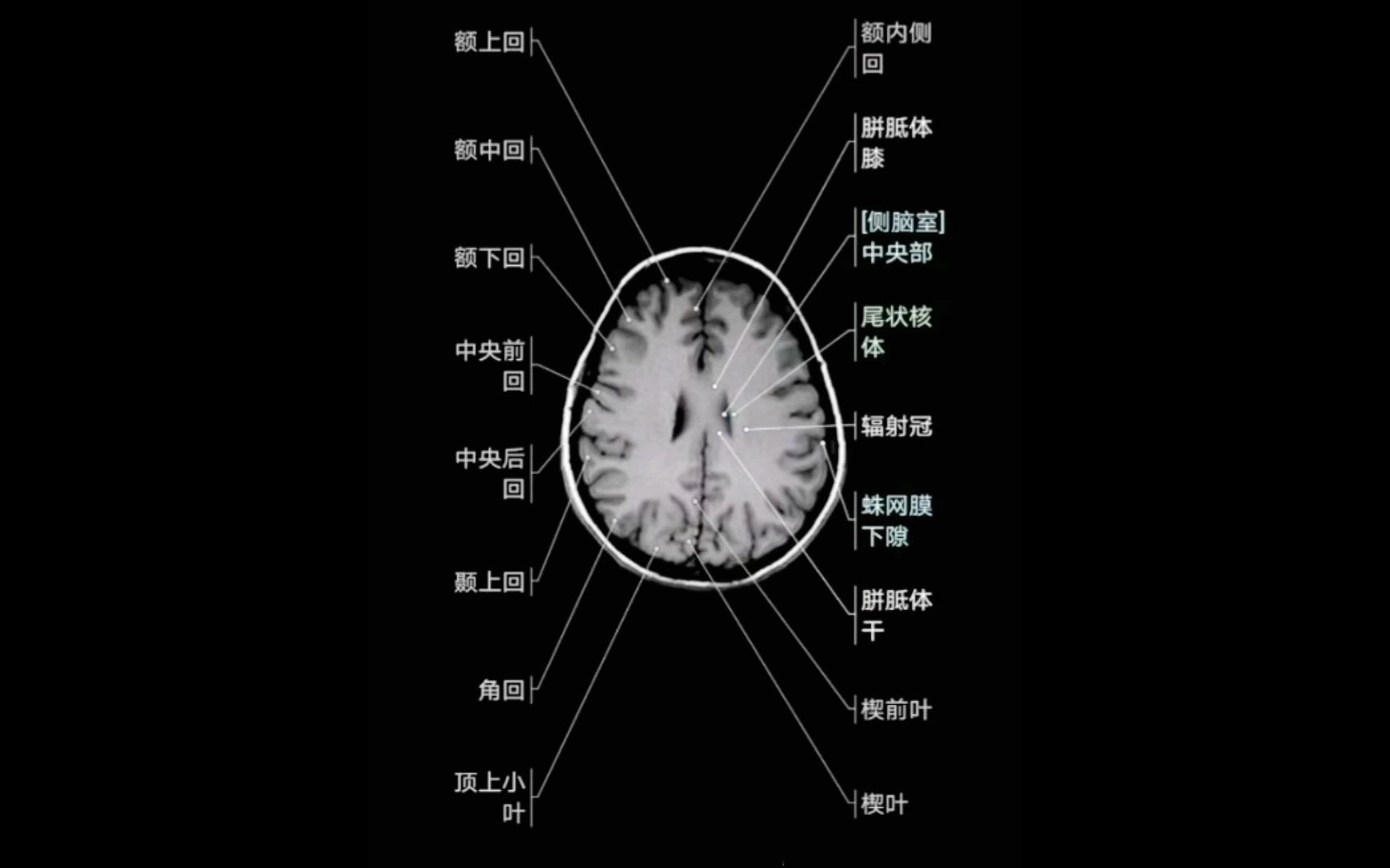 [图]【干货分享】颅脑断层解剖（详解版）