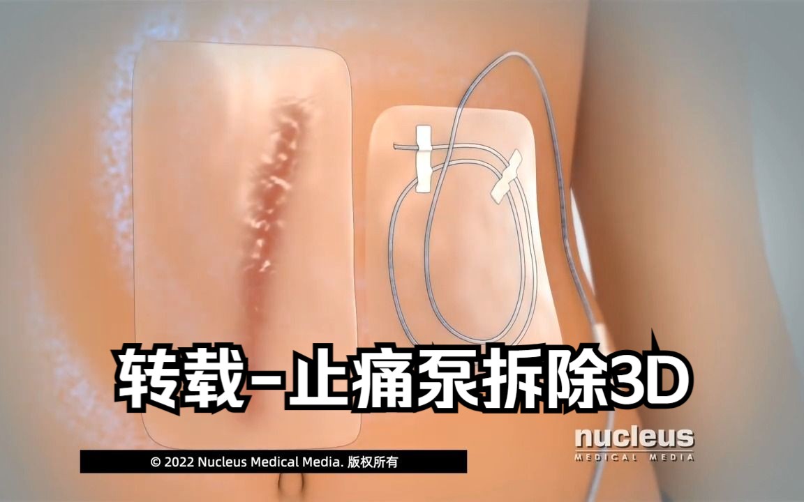 [图]【转载】止痛泵的拆除3D动画【仅供学习交流使用】