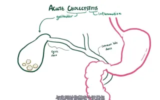 胆囊炎 搜索结果 哔哩哔哩 Bilibili