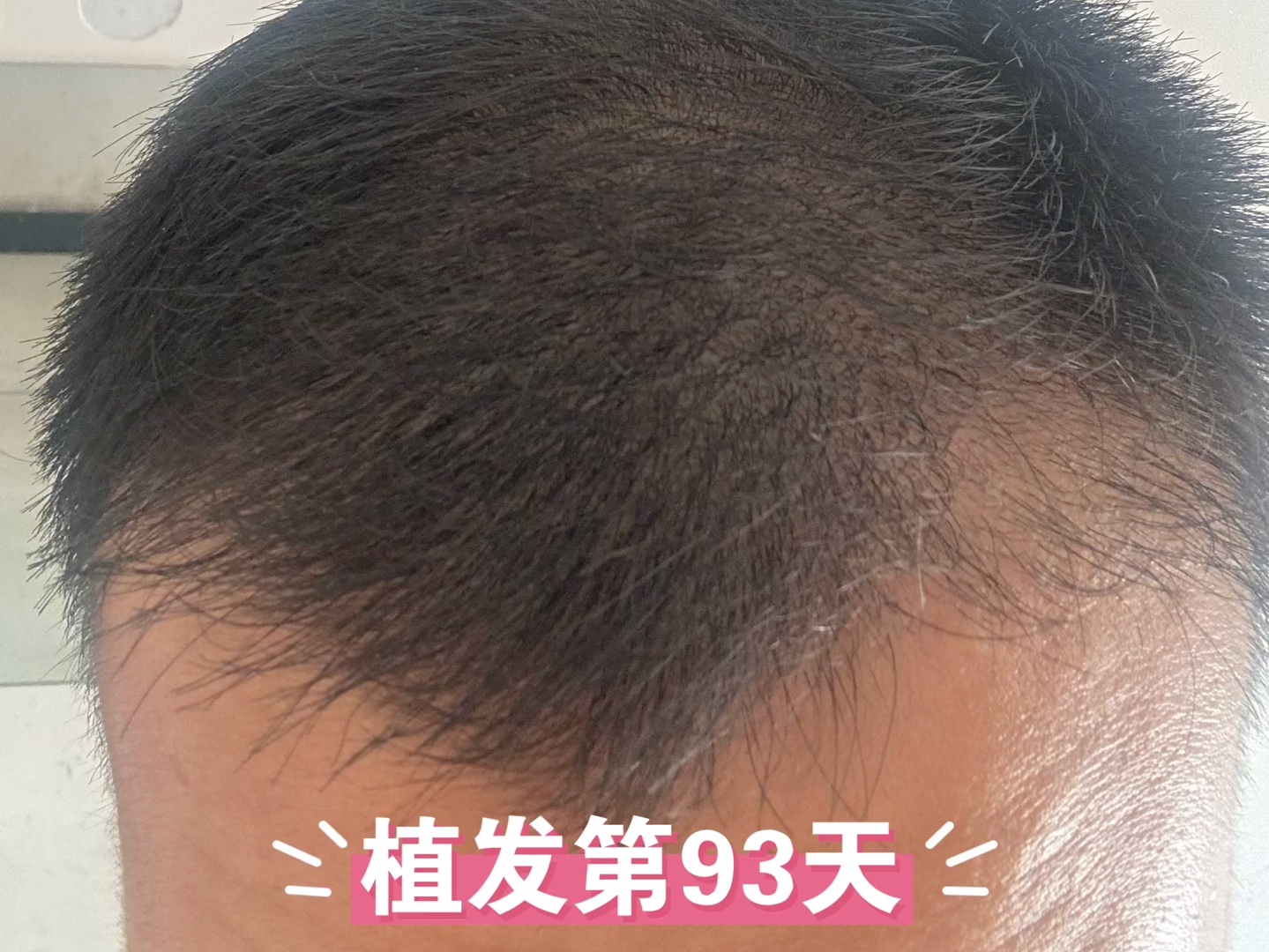 2007年植发(植发几年后的人现在怎么样了)