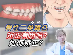 Download Video: 骨性嘴凸≠正颌，该如何正畸呢？不走弯路！