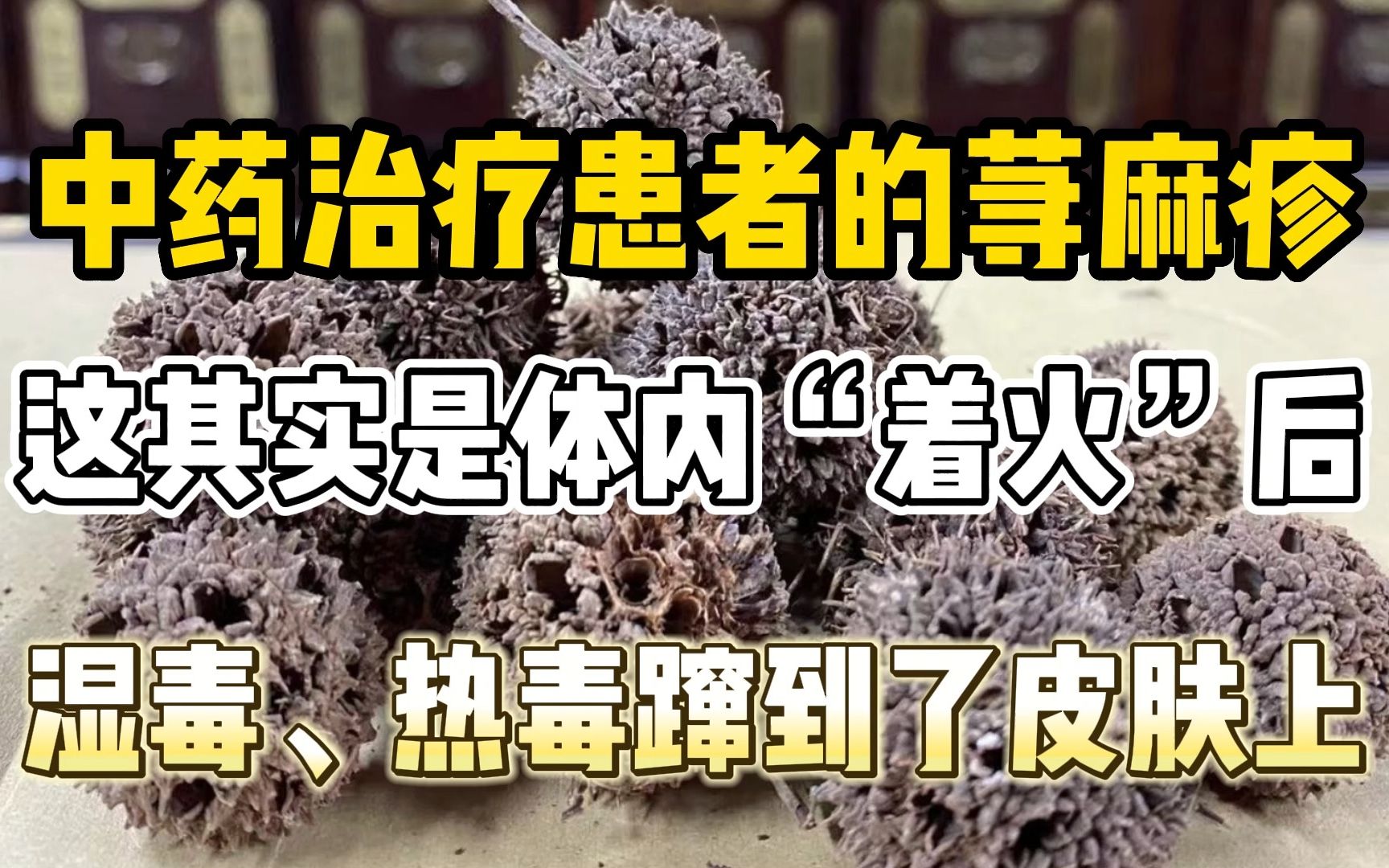 中药治疗患者荨麻疹,这其实是体内着火了,湿毒热毒蹿到了皮肤上哔哩哔哩bilibili