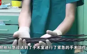 Download Video: 工人作业不慎被14根钢筋戳穿身体 多科室医生联手抢救两小时取出