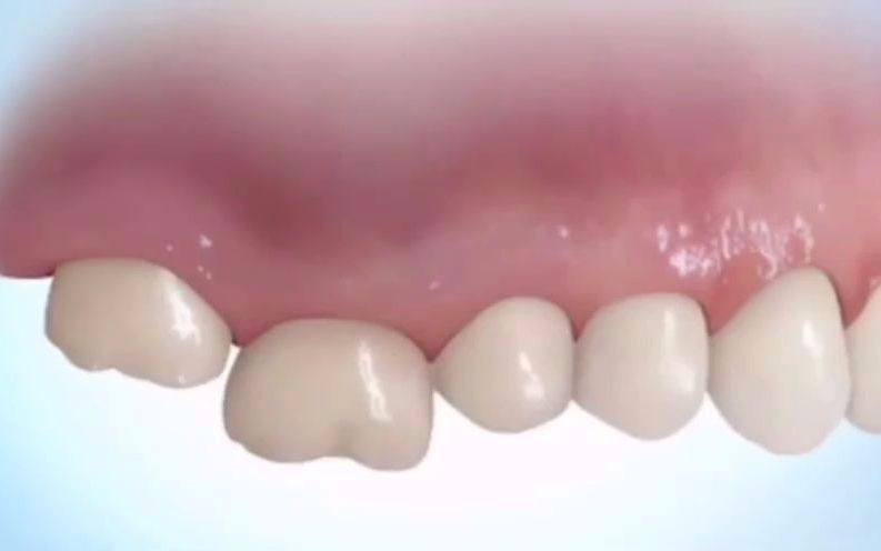 深圳牙齿矫正科普缺牙多年对咬牙伸长通过矫正回位