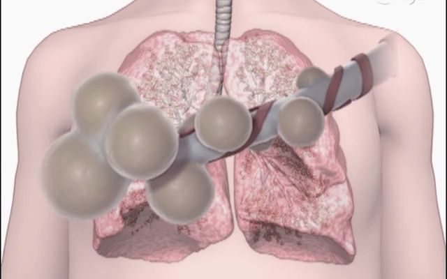 [图]【新英格兰医学杂志NEJM】Monitoring Ventilation with Capnography二氧化碳图监测通气