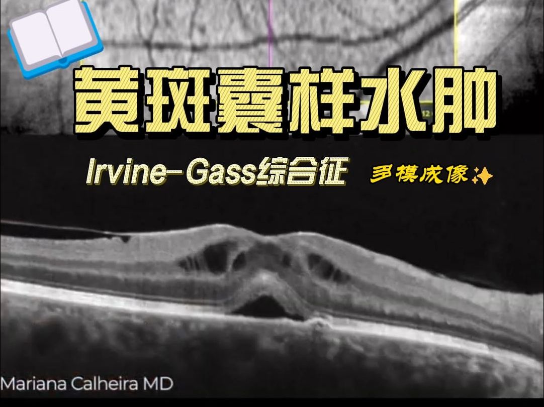 【多模成像】【白内障术后黄斑水肿: Irvine–Gass综合征】Multimodal analysis of Cystoid Macula Edema哔哩哔哩bilibili