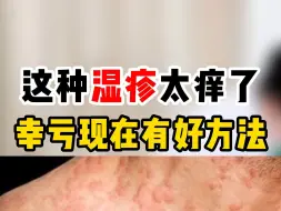 Tải video: 这种湿疹太痒了 幸亏现在有好方法