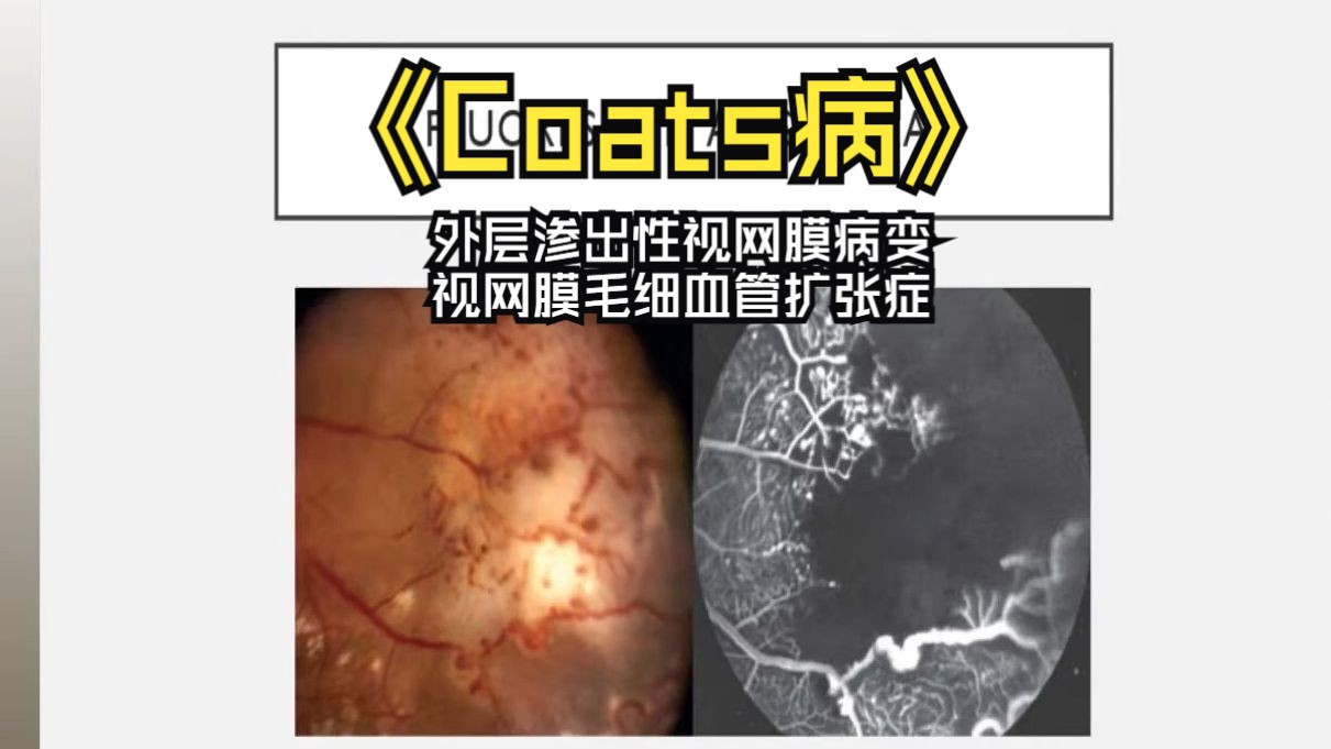 【中英双字】【Coats病:病例报告】 A Case of Coats Disease哔哩哔哩bilibili