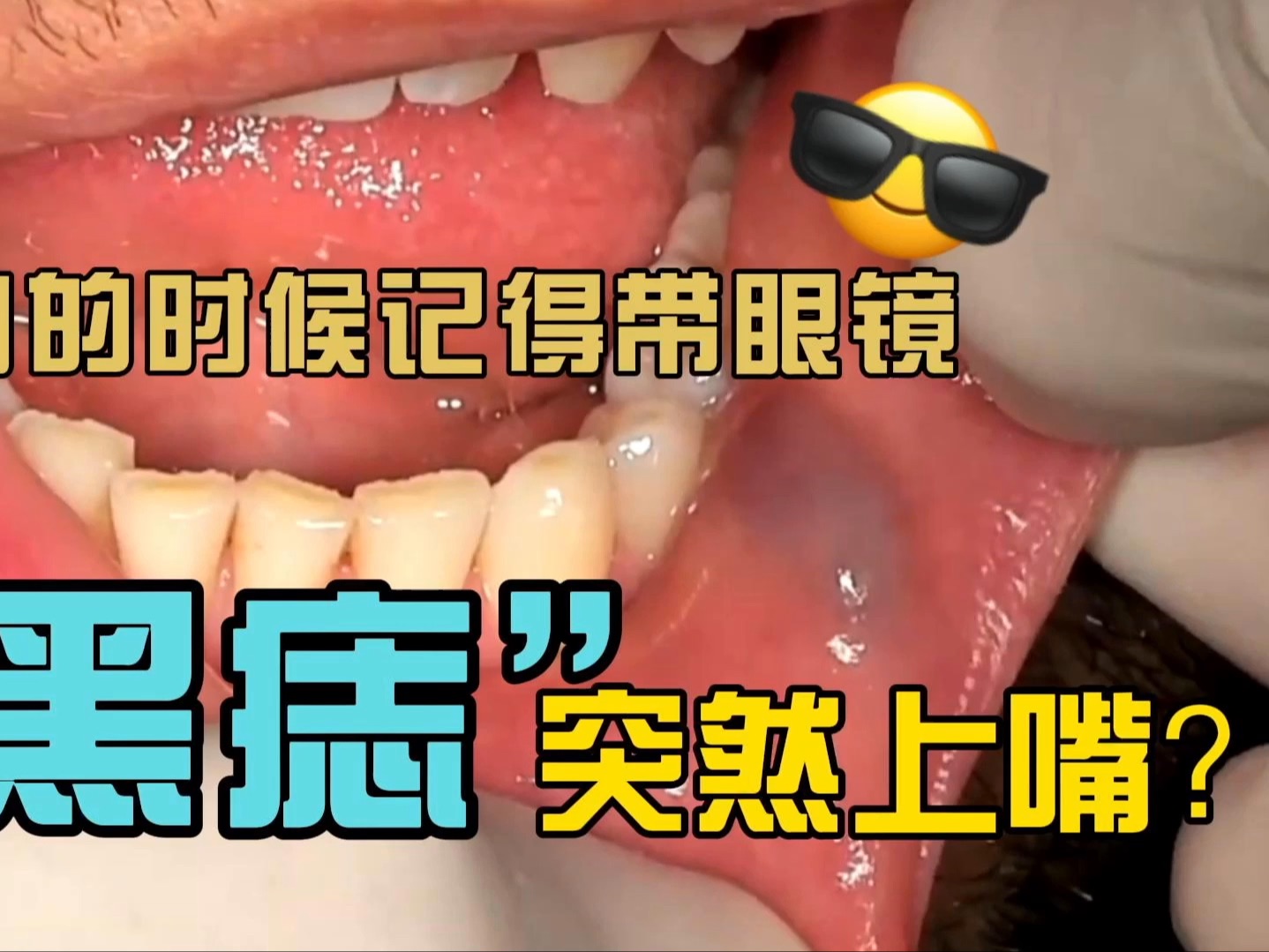 嘴上突然长“黑痣”,小心是静脉湖!治疗过程大揭秘哔哩哔哩bilibili