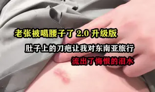 Download Video: 老张被噶腰子，肚子上的刀疤让我对东南亚旅行流出了悔恨的泪水