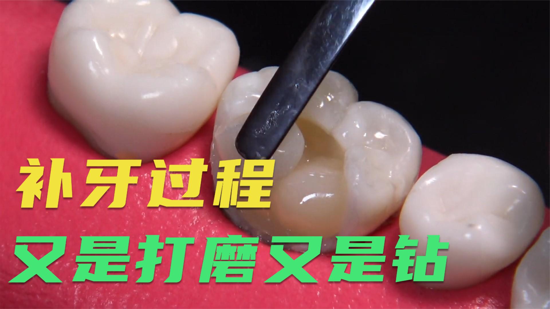 牙齿坏了一大半,又是打磨又是钻,最后修复成果惊艳