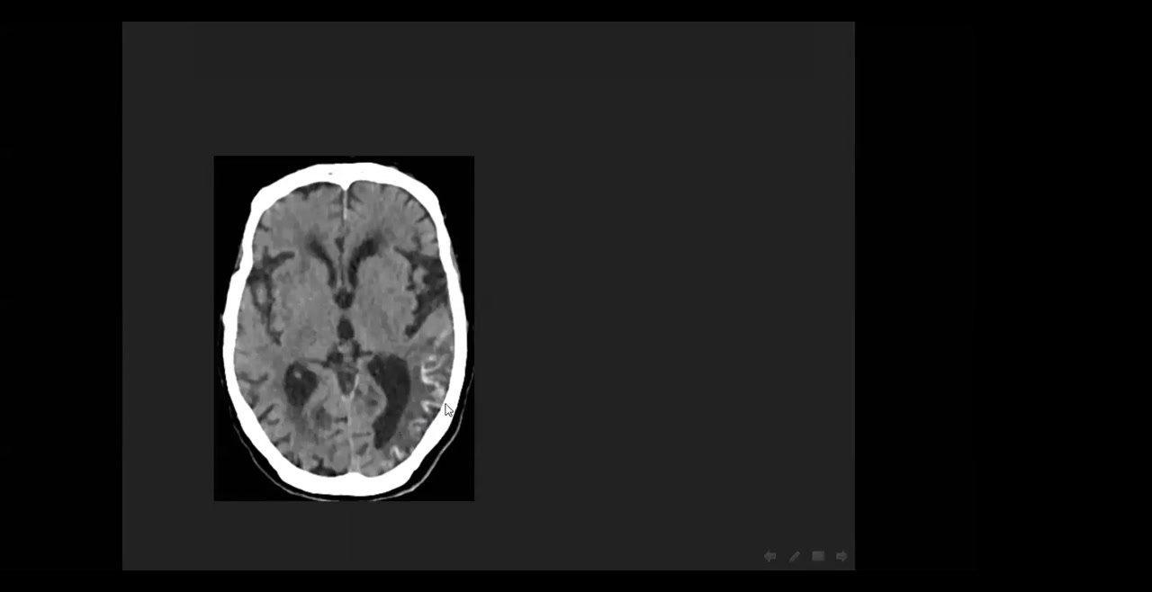 [图]Dangerous signs in Neuroradiology(720P_HD)