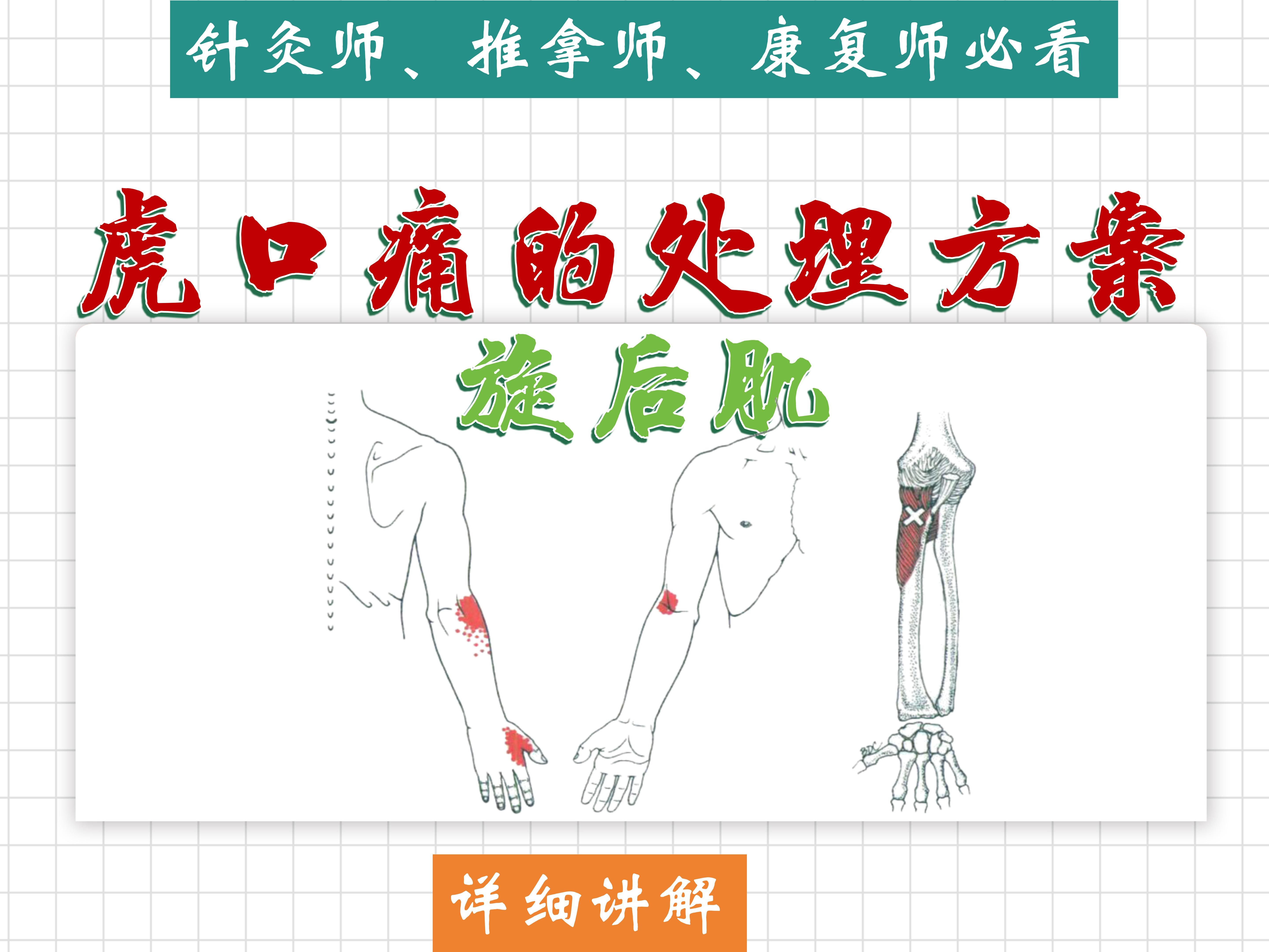 【虎口痛】(旋后肌)详细讲解——位置、功能、激痛点、处理方法——天下明医平台简灵奇针哔哩哔哩bilibili