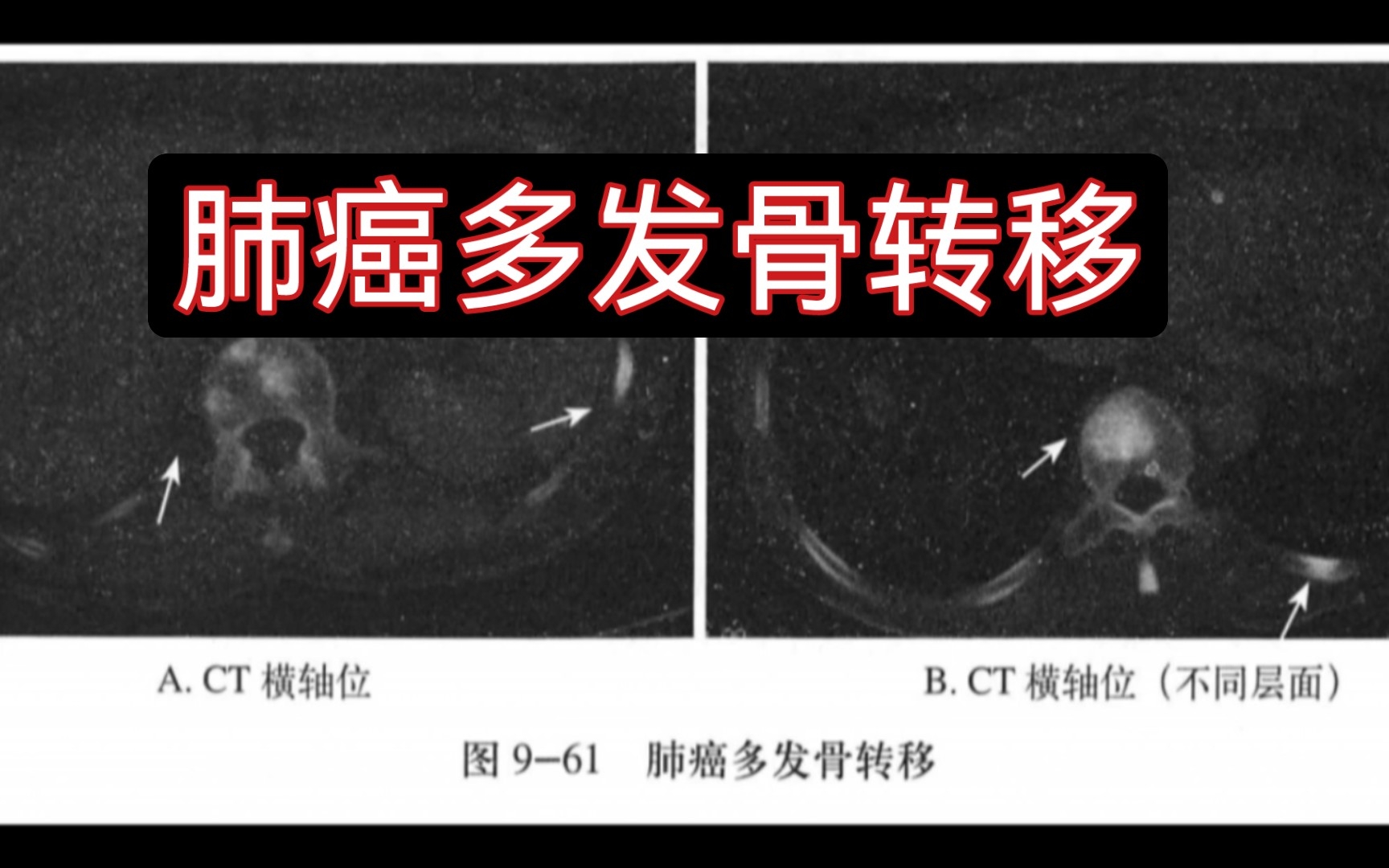 【医学影像】跟我一起刷病例 | 肺癌多发骨转移哔哩哔哩bilibili