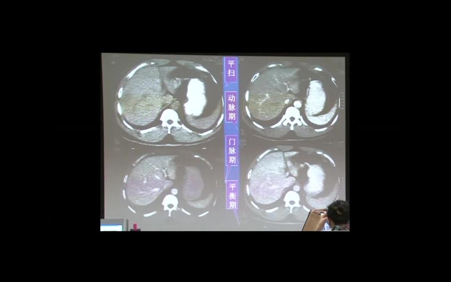 [图]09肝胆胰脾--中山大学《放射诊断学》
