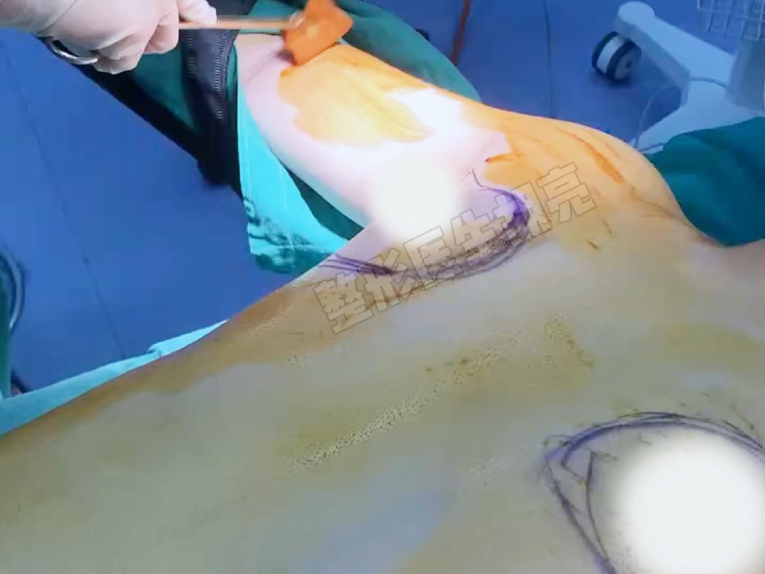 沉浸式体验男士缩胸全过程