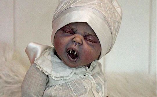 婴儿罹患怪病酷似吸血鬼,医生通过新疗法在子宫内治愈