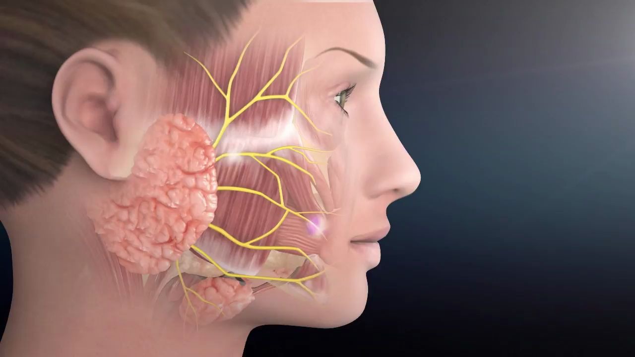 【中英字幕】微创腮腺Parotid Surgery Animation Overview of Minimally Invasive Parotidectomy哔哩哔哩bilibili