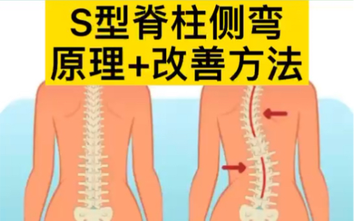 S型脊柱侧弯调整~适合每一个人!小习惯大改变,记得养成良好的坐姿,站姿,走路姿势,才能从根本解决脊柱侧弯问题哔哩哔哩bilibili