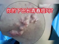 Descargar video: 你的青春痘长啥样？千万别用手抠了！